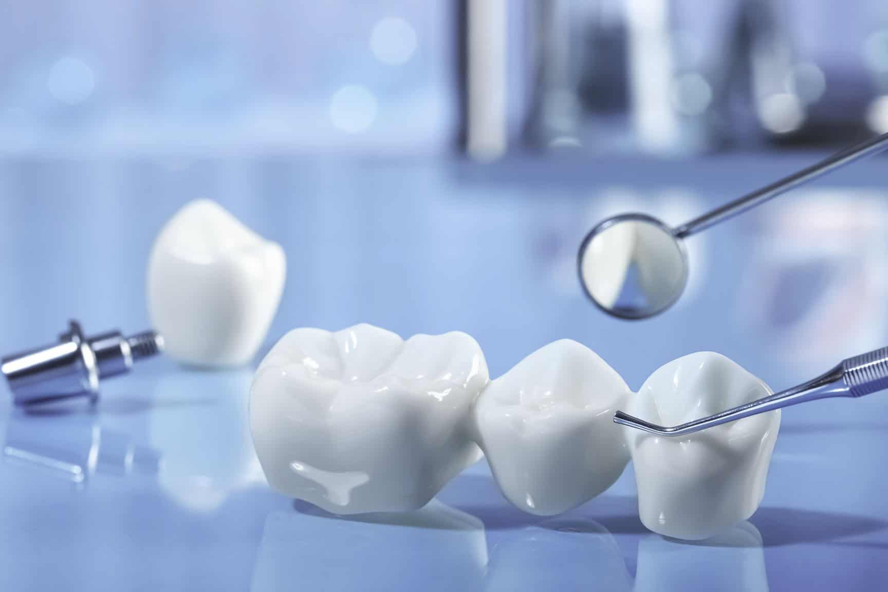 Dental Bridges