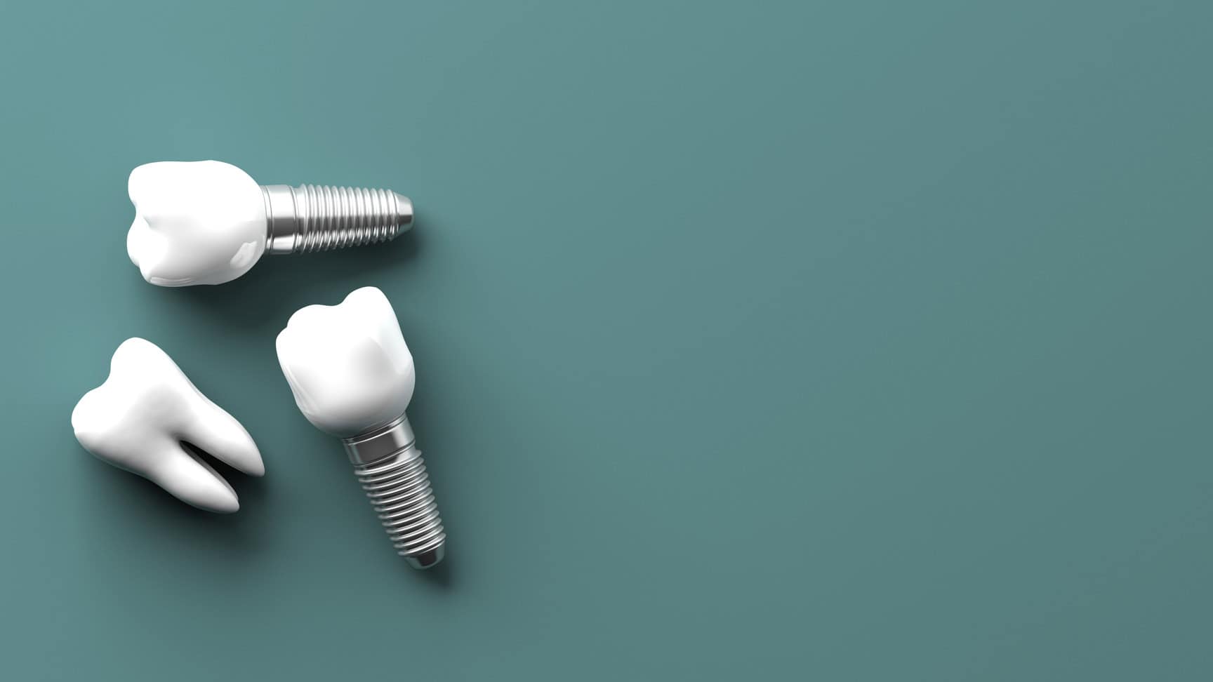 Dental Implants